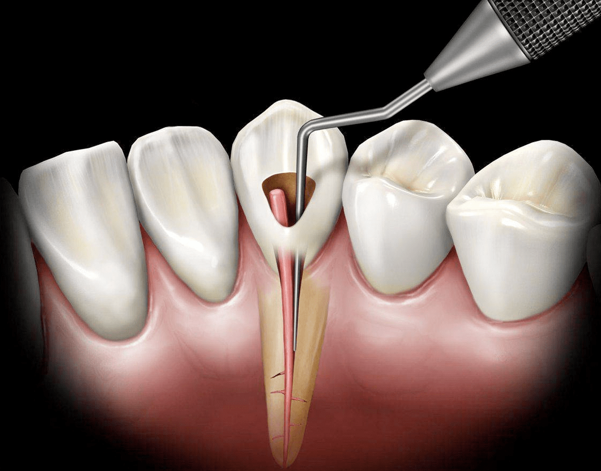 Эндодонтическое лечение зуба