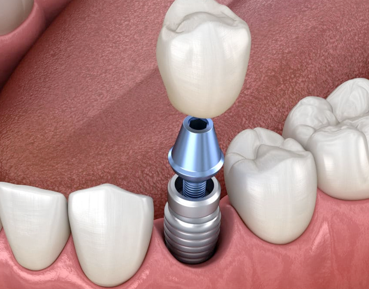 Металлокерамическая коронка на имплантат зуба
