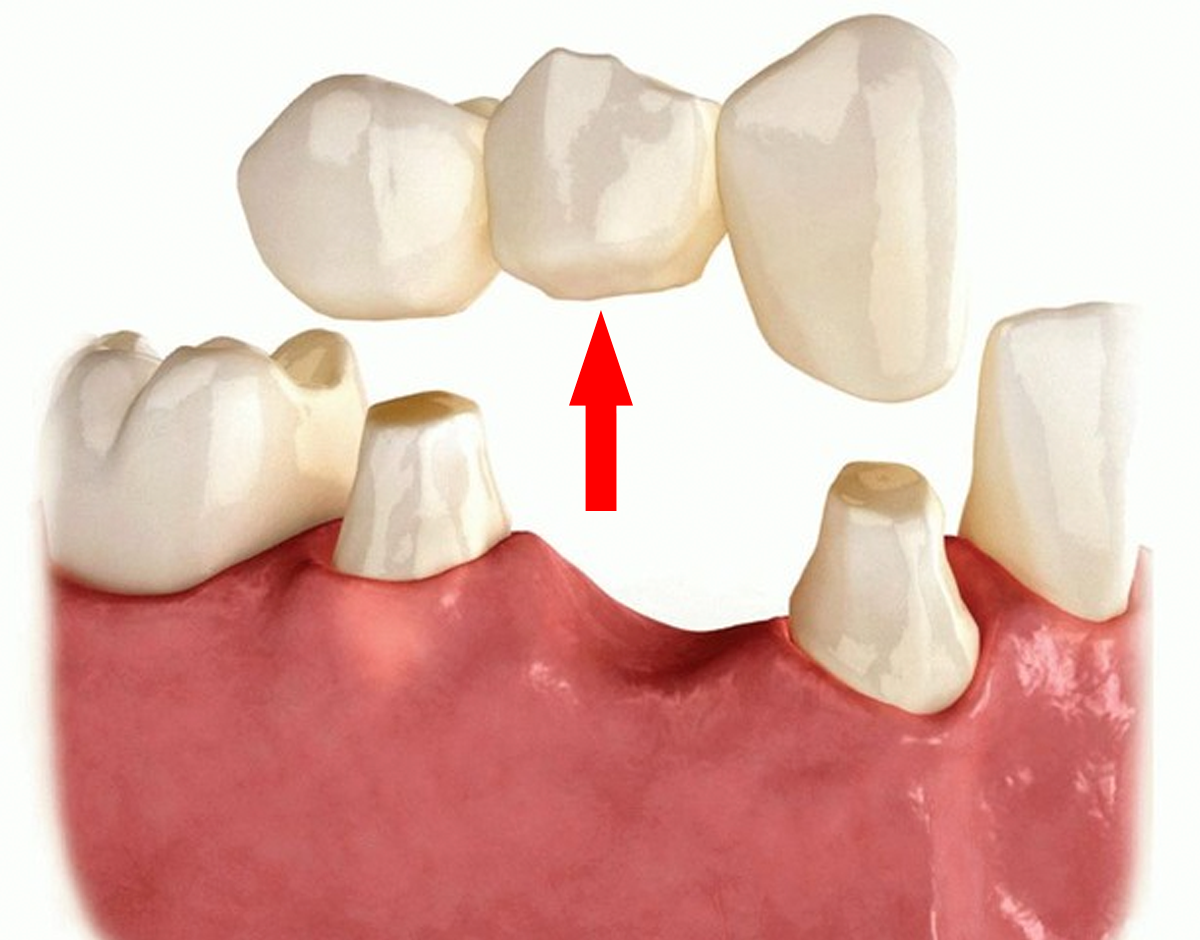 Металлокерамический зуб